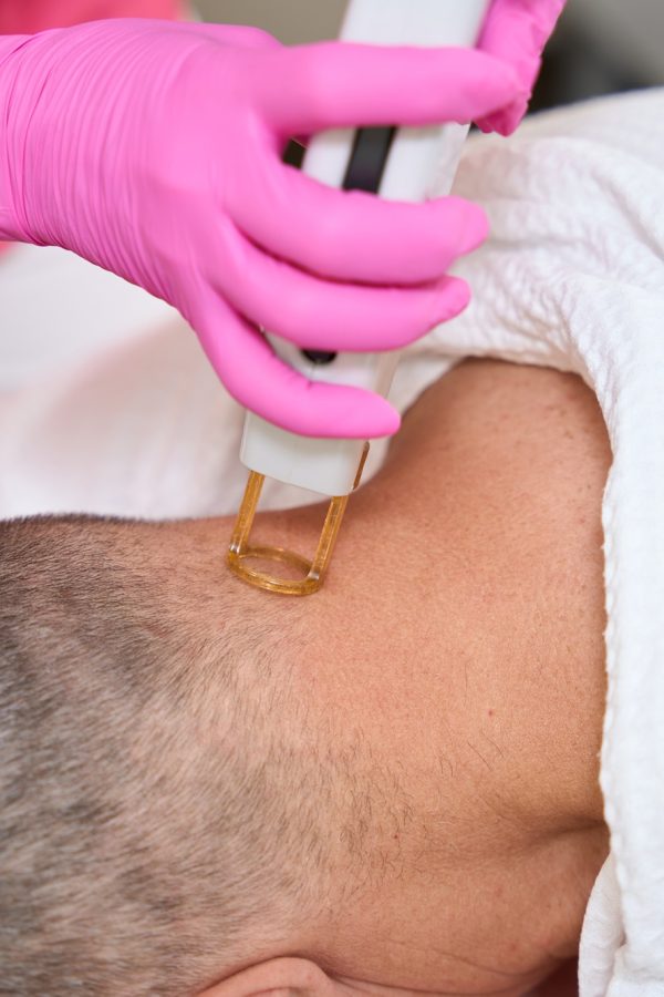 Female hands with laser epilator remove hair on back head Female hands with laser epilator remove hair on back head