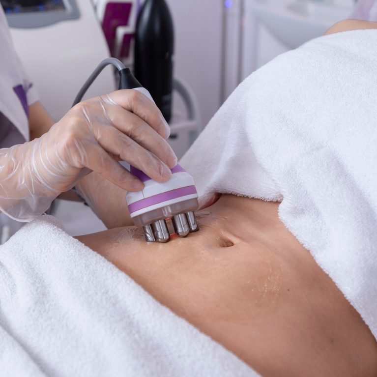 Radiofrequency body treatment of abdomen ,Non-surgical body sculpting
