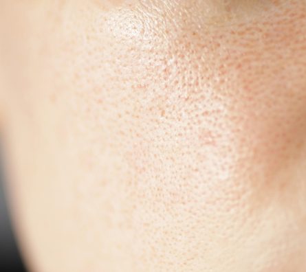 Skin texture, unhealthy with with enlarged pores and rosacea, red rashes. Allergic and redness. Skin texture, unhealthy with with enlarged pores and rosacea, red rashes. Allergic and redness.